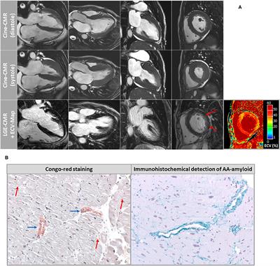 Diagnosis of Cardiac Involvement in Amyloid A Amyloidosis by <mark class="highlighted">Cardiovascular Magnetic Resonance Imaging</mark>